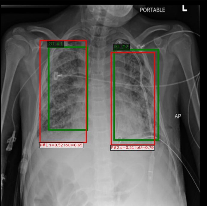 FCOS Pneumonia Detection